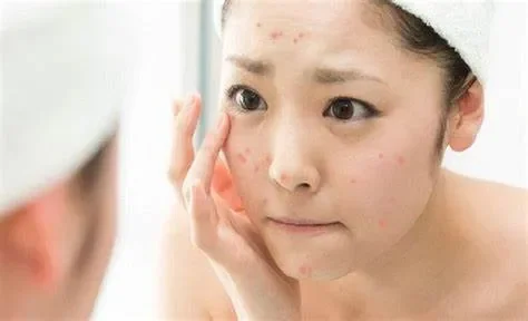 Dầu Thừa và Mụn Liên Quan Như Thế Nào?