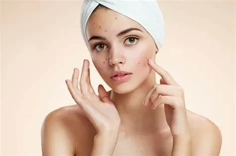 Định nghĩa thâm mụn