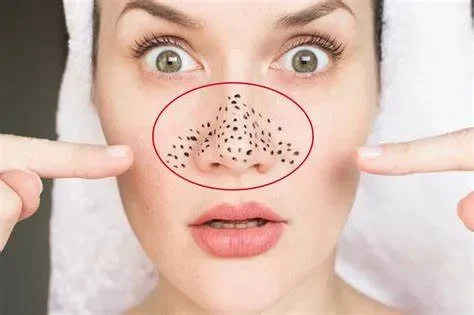 Mẹo Giảm Mụn Đầu Đen Hiệu Quả