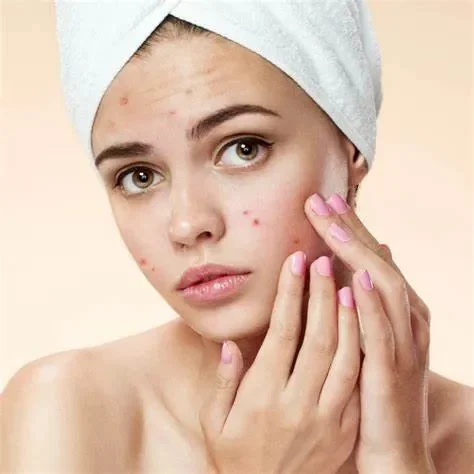 Mụn Thâm Là Gì? Phân Biệt Với Các Loại Mụn Khác